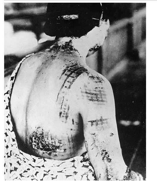 patient's burns hiroshima