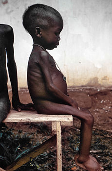 STARVED GIRL - NIGERIA