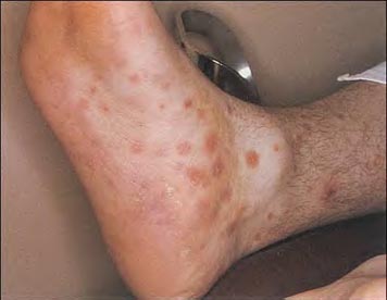 gonorrhea skin rash